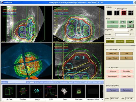 Prostate IMRT dose distribution 