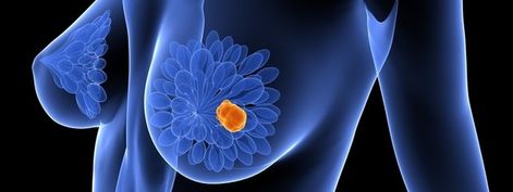 C&eacute;lulas inmunitarias favorecen la progresi&oacute;n del c&aacute;ncer de mama